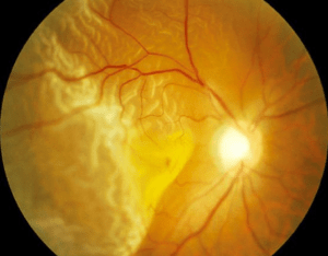 esclarecimentos sobre Descolamento de retina