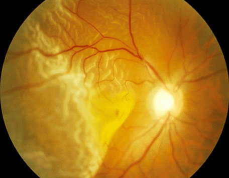 esclarecimentos sobre Descolamento de retina