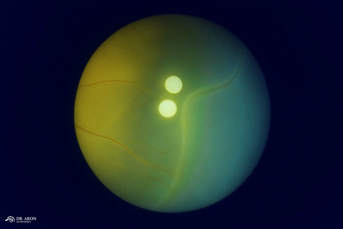 Retinopatia da Prematuridade