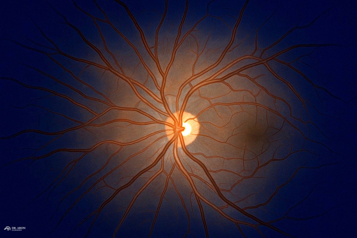 Estrias Angioides