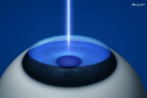 cirurgia refrativa