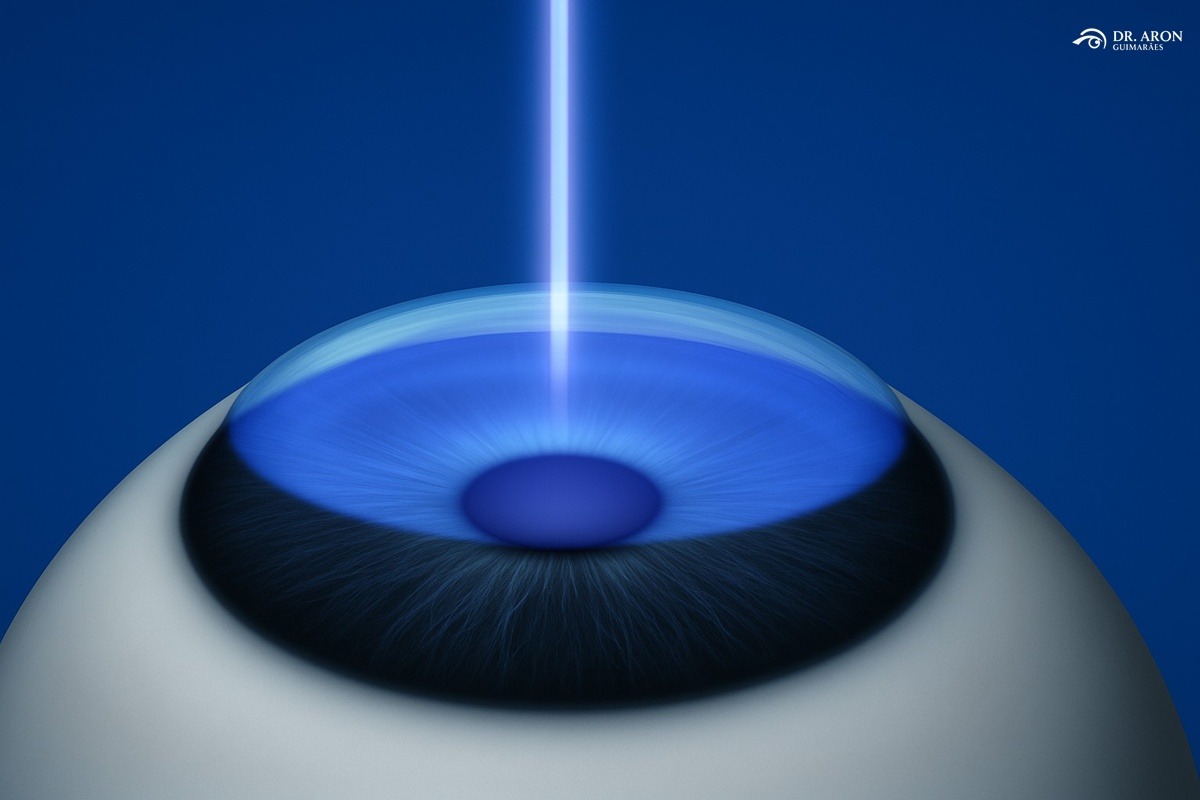 cirurgia refrativa