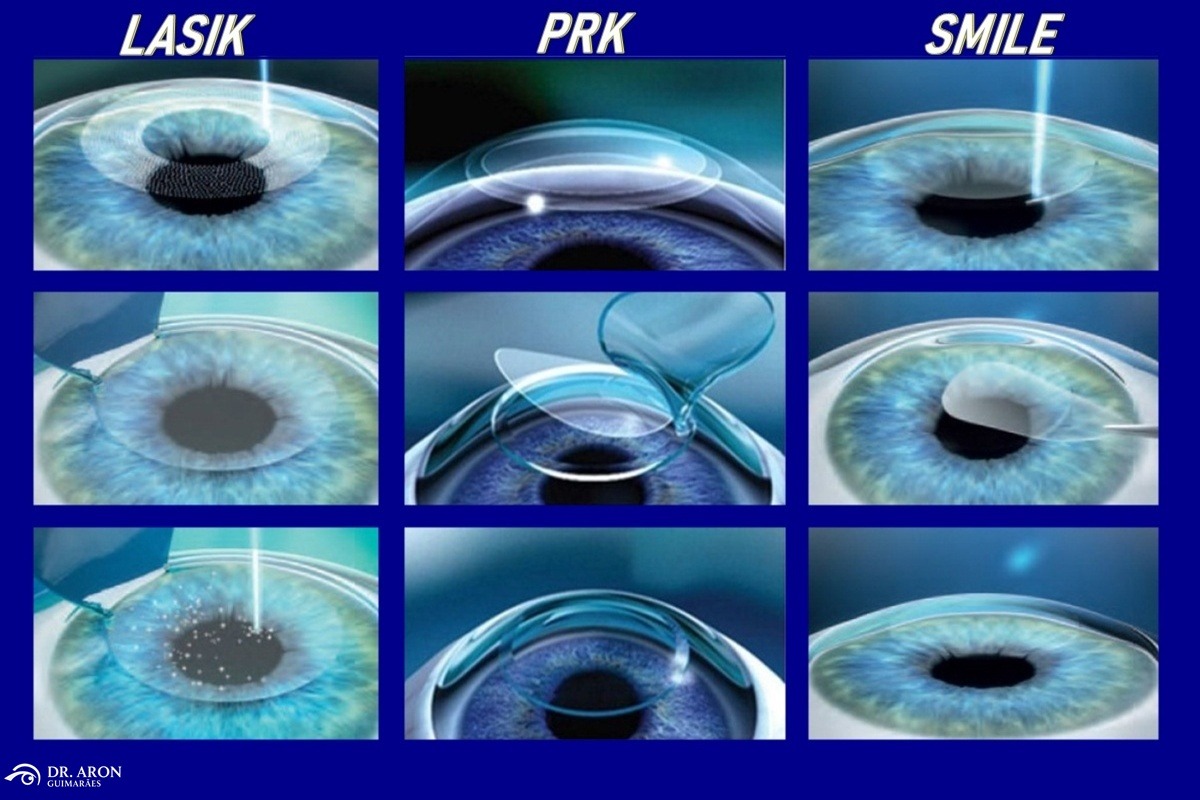 3 TIPOS de cirurgia refrativa