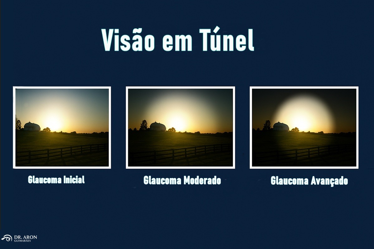 Visão de Glaucoma