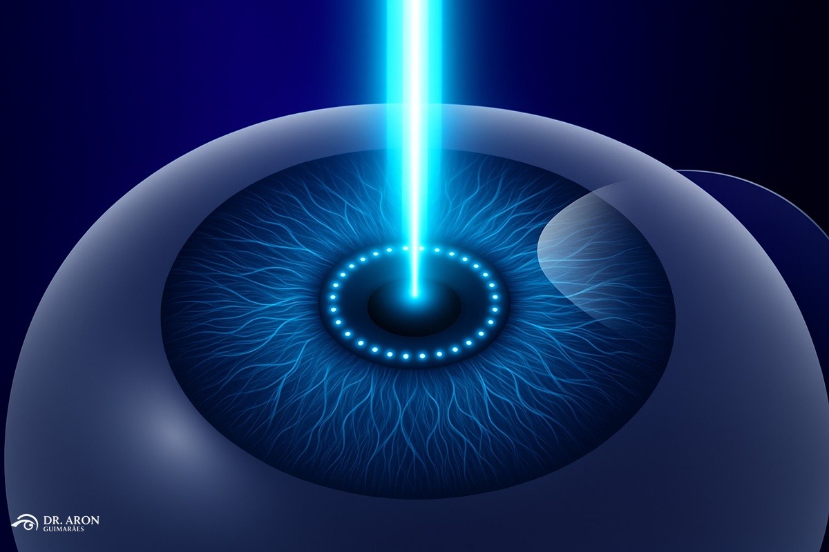cirurgia refrativa