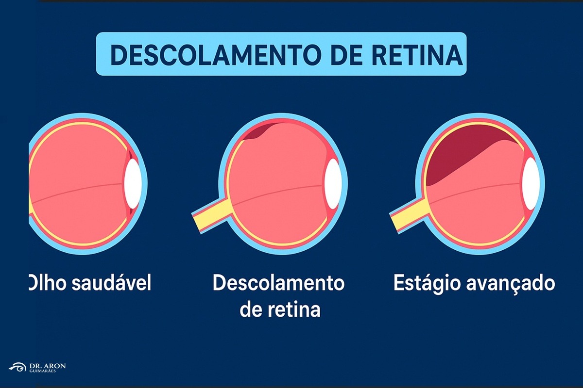 deslocamento da retina