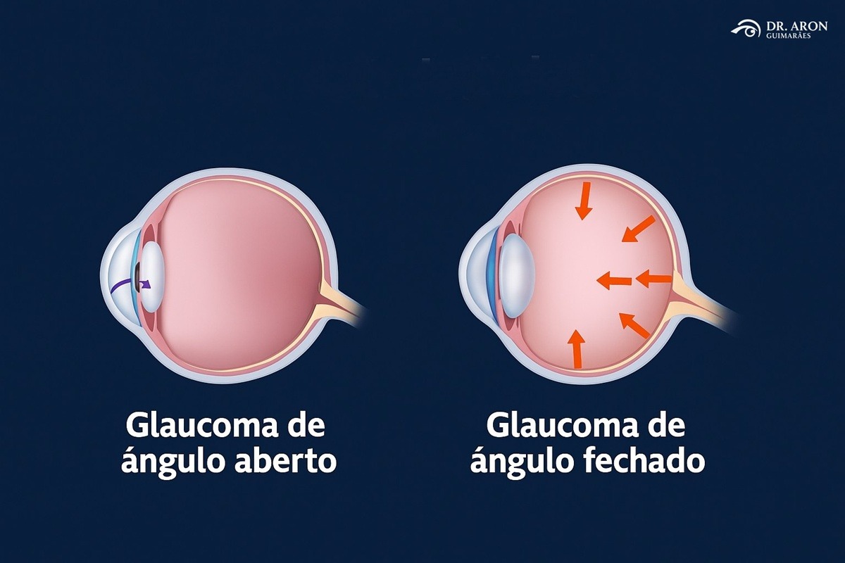 glaucoma