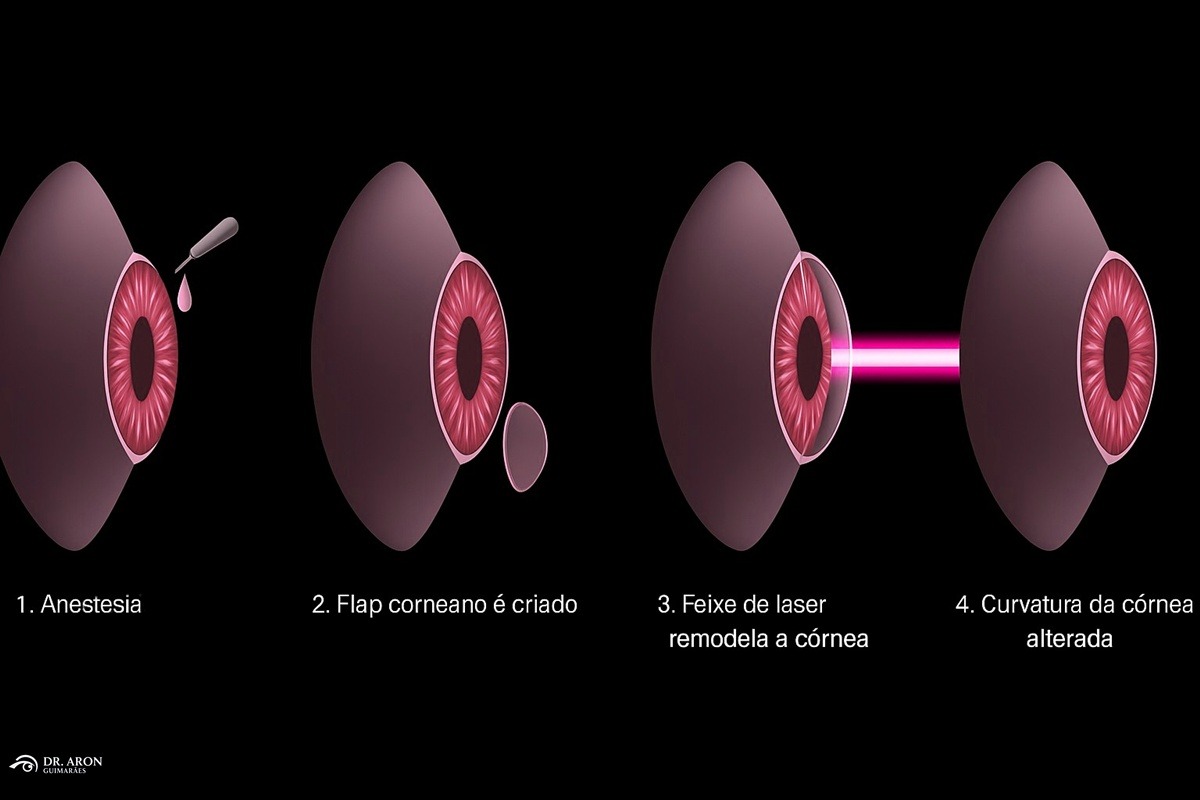 lasik
