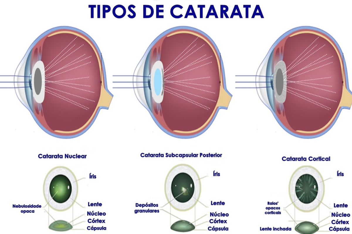 tipos de catarata
