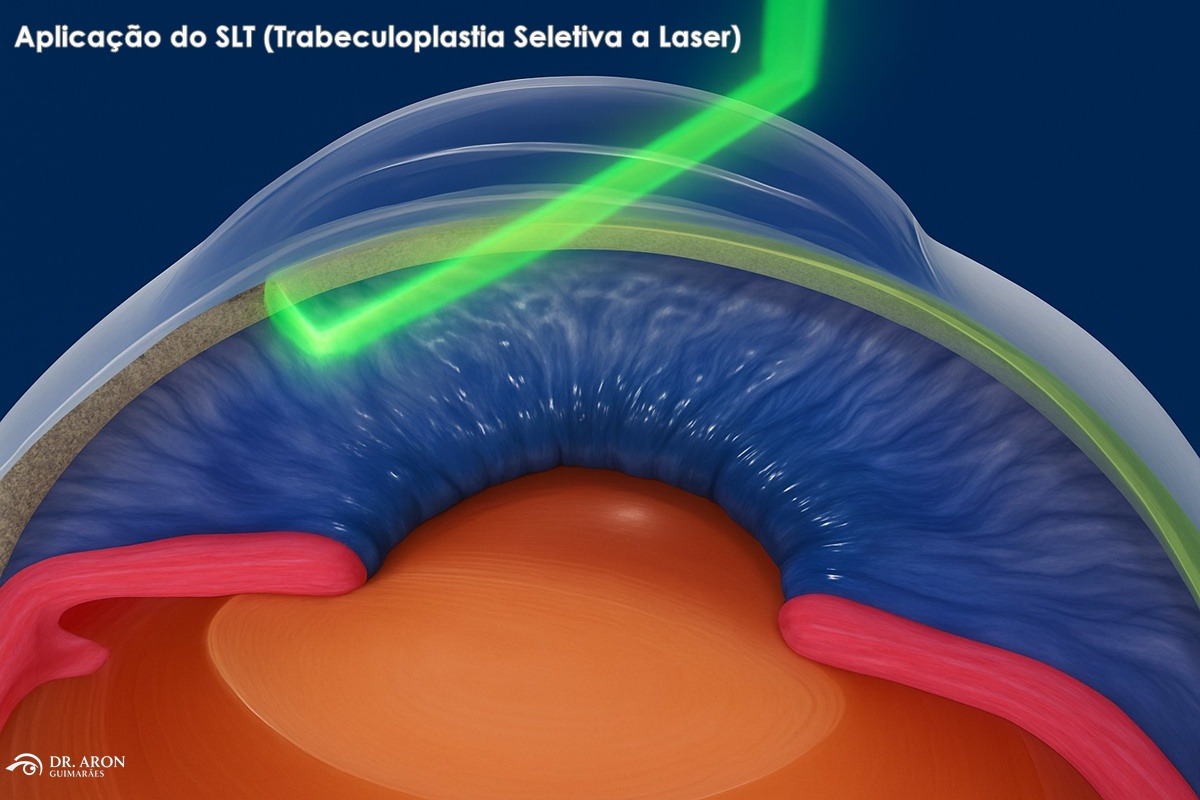 tratamento do glaucoma a laser