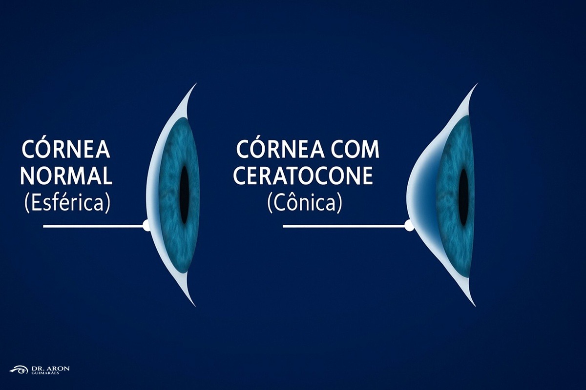 ceratocone