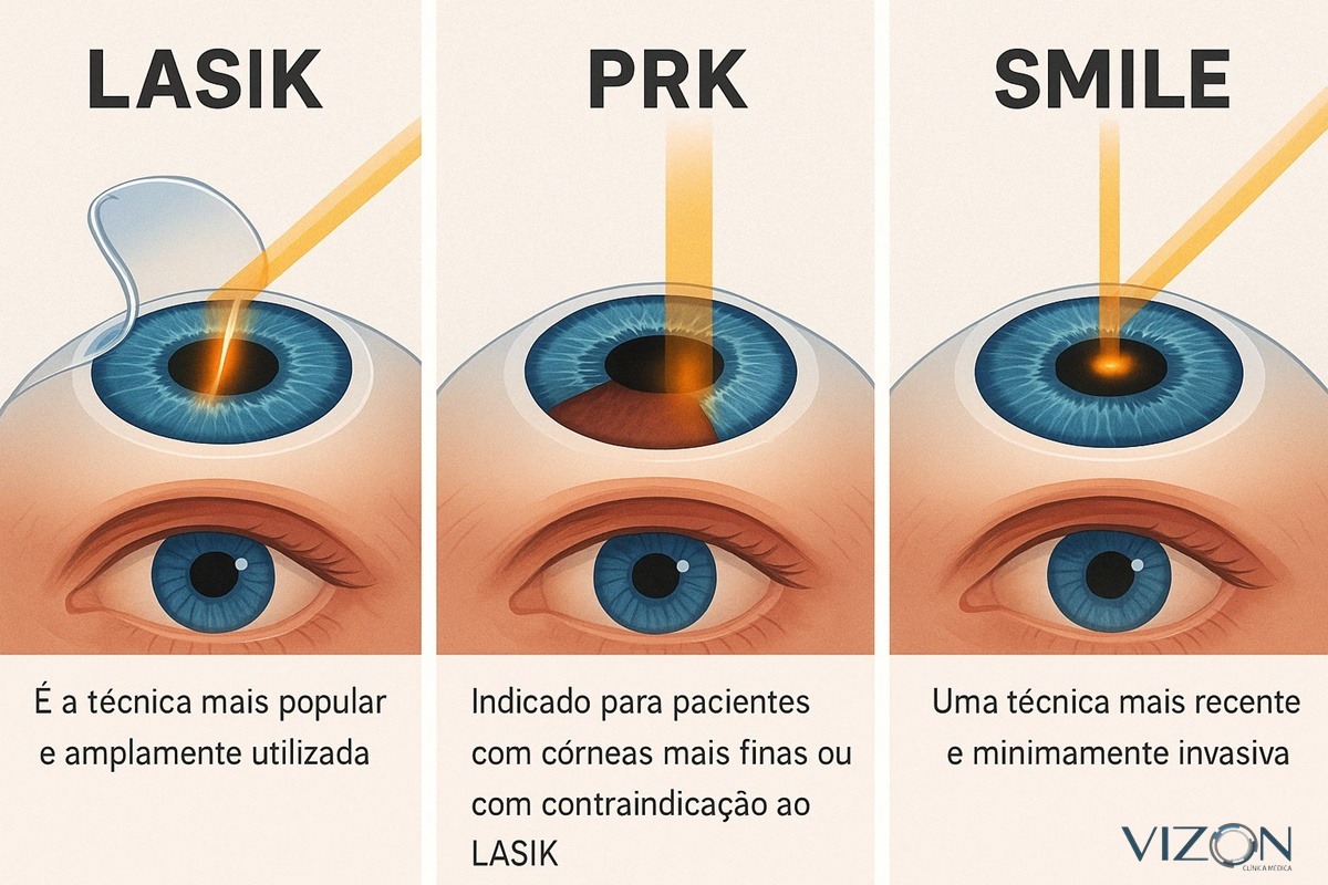 tecnicas cirurgia refrativa