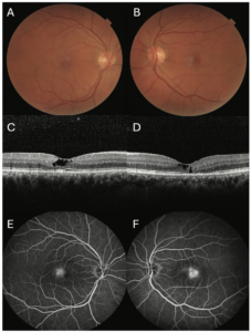 retinal-telangiectasia-causes